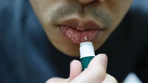 5 Ingredients In Lip Balms That Cause Dry And Chapped Lips