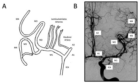 Middle Cerebral Artery Angiogram