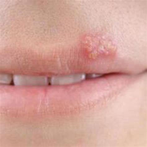 【图】嘴附近长痘痘是什么原因？ 4个重要原因告诉患者_嘴附近长痘痘是什么原因_伊秀美容网|yxlady.com