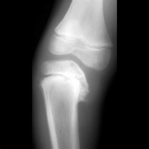 Toddler with bowing of the right knee | Pediatric Radiology Case | Pediatric Imaging ...