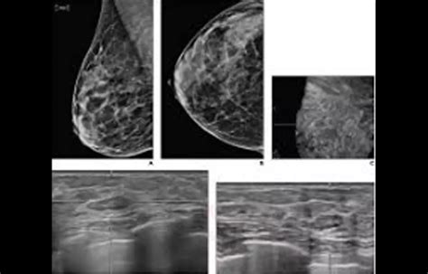Routine annual screening for ABUS BI-RADS 3 lesions substantially ...