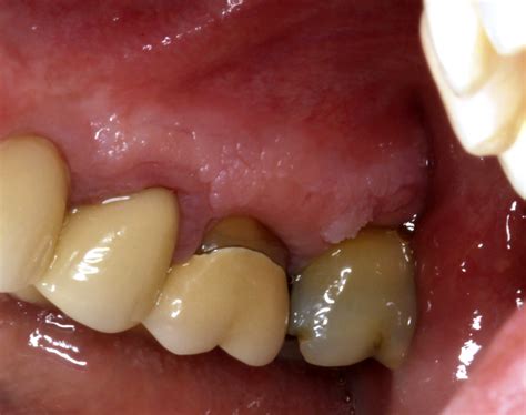 Pathology Outlines - Leukoplakia