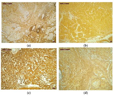 Chronic Diarrhea Caused by Vasoactive Intestinal Peptide-Secreting Tumor