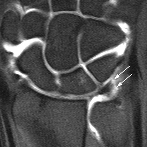 Peripheral Tear of the Triangular Fibrocartilage: Depiction with MR ...