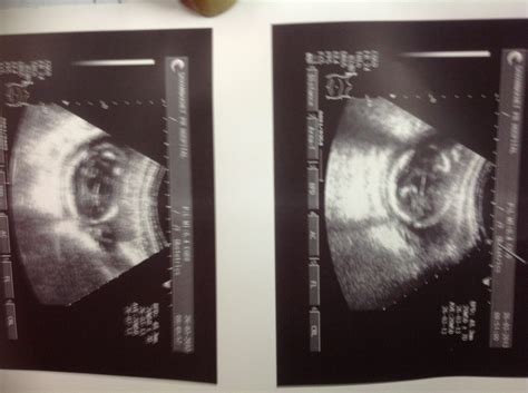 怀胎十月1-40周婴儿发育过程图(1-20周)
