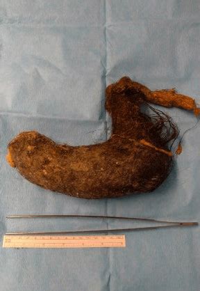 Trichobezoar: the importance of a multidisciplinary approach ...