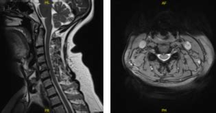 Image result for Subacromial Decompression Rotator Cuff Repair