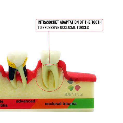 Periodontal Disease Model-Stages of Periodontitis – HomoSapiens
