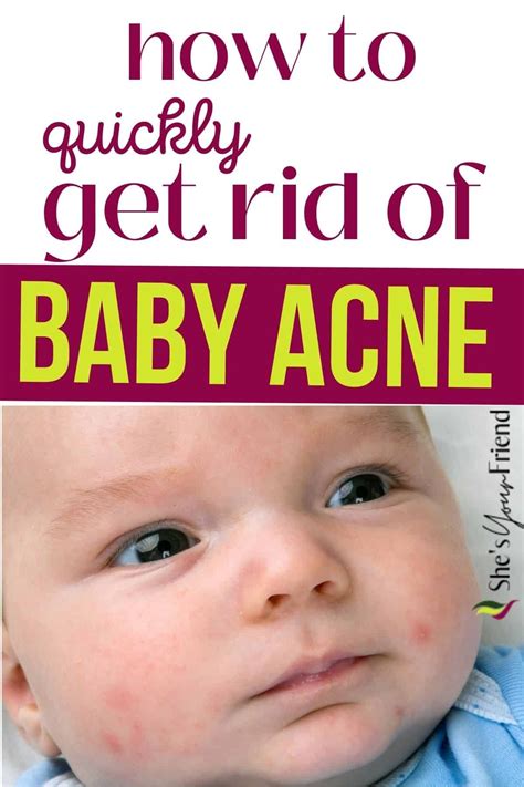 How to get rid of baby acne – Artofit