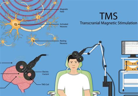 TMS Therapy in Atlanta, GA