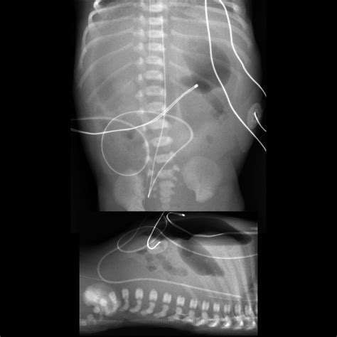 Pediatric Spontaneous Intestinal Perforation | Pediatric Radiology Reference Article | Pediatric ...