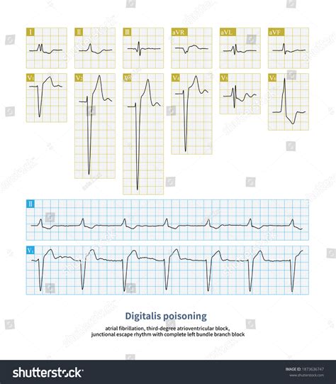 Ventricular Escape Rhythm