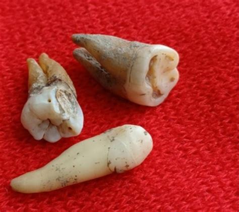 Image result for Medieval Tooth Extraction
