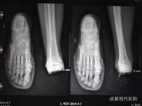 足踝离断患者术后5个月恢复情况视频-成都现代医院