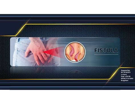 Fistula - Prepared by: Mr. Mewan K Lecturer Dept. of MSN RR ...