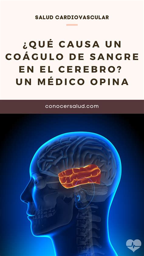 ¿Qué causa un coágulo de sangre en el cerebro? Un médico opina ...