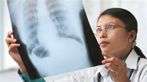 About Active Tuberculosis Disease | Tuberculosis (TB) - Apartment Times ...