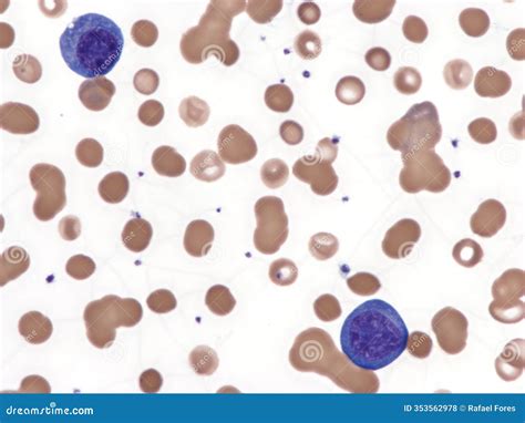 Plasma cell leukemia. stock photo. Image of plasma, cell - 353562978