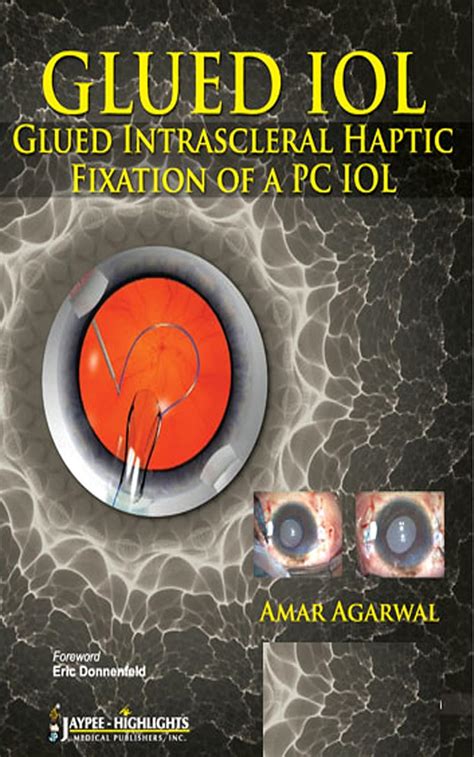 Glued IOL: Glued Intrascleral Haptic Fixation of a PC IOL eBook : Amar ...