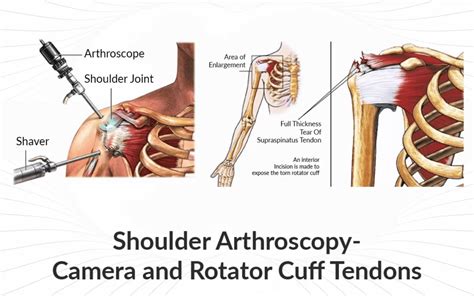 Image result for Post Rotator Cuff Surgery