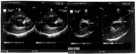 Fetoscopic Myelomeningocele Repair with Complete Release of the ...