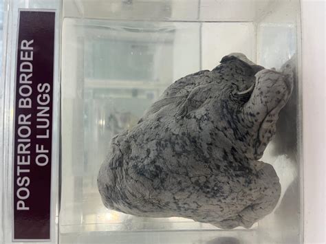 POSTERIOR BORDER OF LUNG | NAMO Medical Education & Research Institute