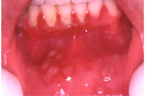 What Does Herpes Feel Like Mouth at Lemuel Jolly blog