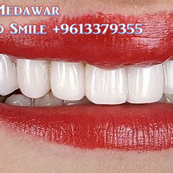 Direct Veneers | Composite Veneers Lebanon