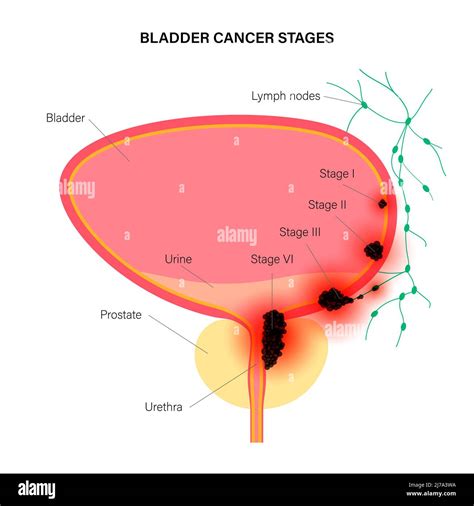 Bladder cancer stages, illustration Stock Photo - Alamy