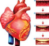 Non-progressive coronary artery disease