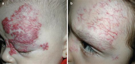 Image result for Hemangiosarcoma