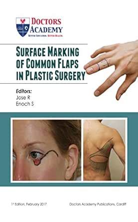 Surface Marking of Common Flaps in Plastic Surgery eBook : M Jose ...