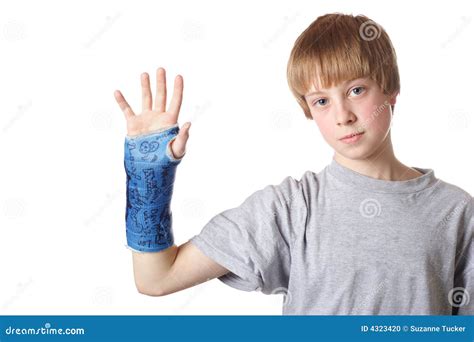 Broken Wrist Cast
