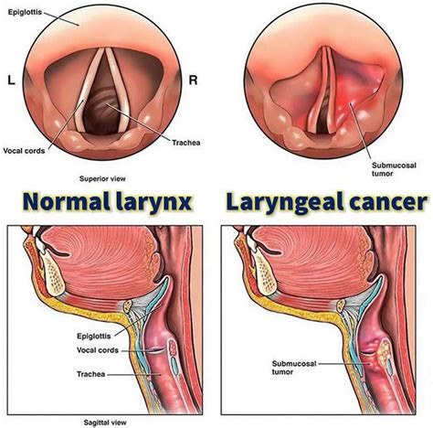Larynx - Anatomy, Function in Respiratory System - Cancer Symptoms - carcinoma of the larynx symptoms