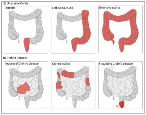 Ulcerative Colitis Symptoms Causes Treatment