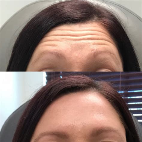 Neurotoxin - Aesthetic Element