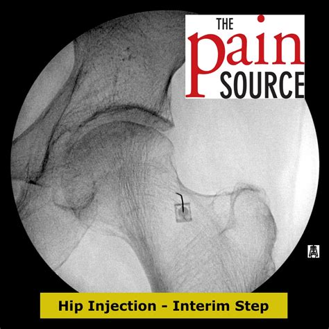 Hip Joint Injection With Fluoroscopy - Technique and Tips - ThePainSource.com