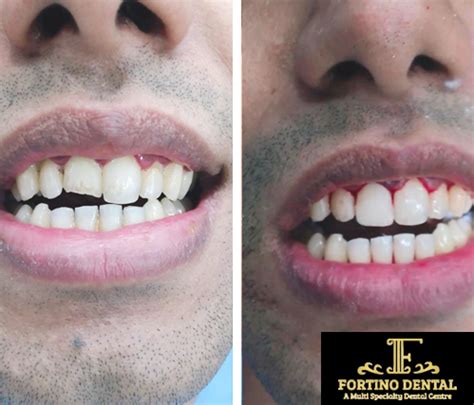 Fortino Dental - Best Dental Clinic in Delhi