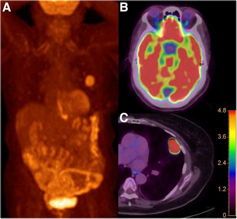 Confirmation of Intracranial Neuroendocrine Metastasis Using 68Ga-DOTATATE PET/CT | Journal of ...