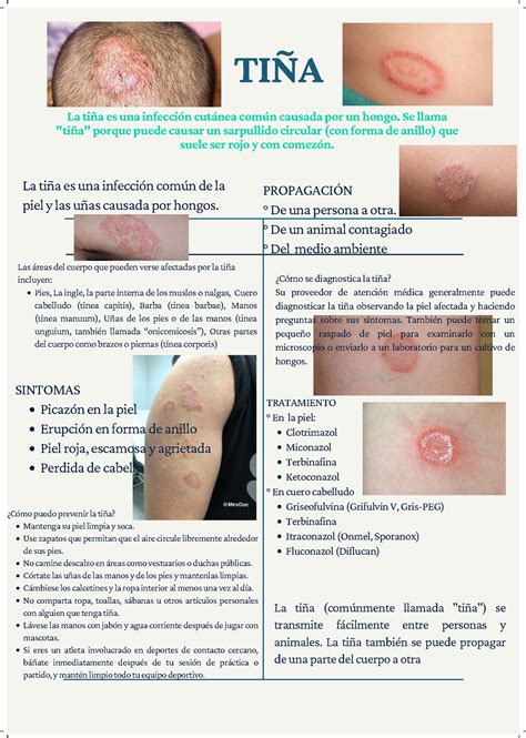 TIÑA - Apuntes 1 - La tiña es una infección cutánea común causada por ...