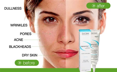 Ducray Keracnyl PP Cream 30 ml : Amazon.in: Beauty