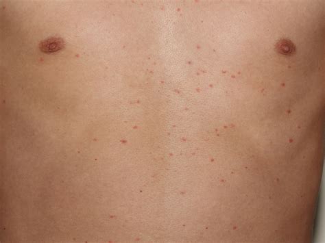 Pityriasis Rosea - Causes, Rash, Herald Patch, Stages, Treatment