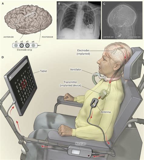 Brain-driven speech computer aids communication of ALS patient