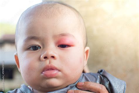 little baby infection at the eyelid caused by being bitten by insects ...