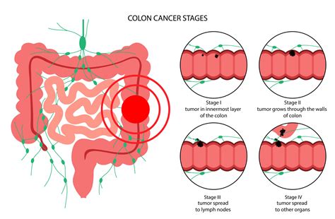 CÁNCER DE COLON - Dr Neeraj Singh MD FACS FASCRS