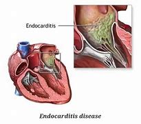 endocarditis 的图像结果