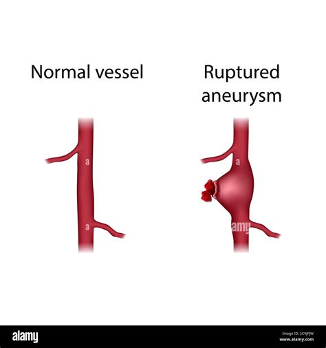 Normal vessel and ruptured aneurysm comparison, illustration. An ...
