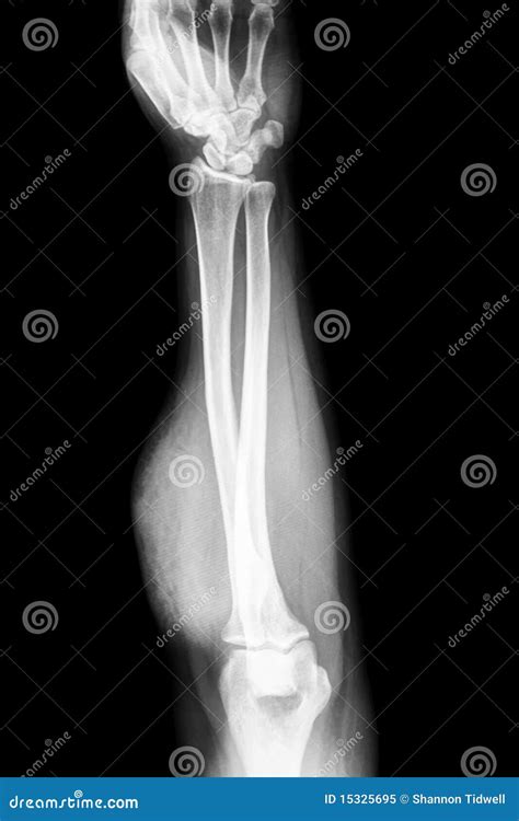 Forearm X-ray Royalty-Free Stock Photo | CartoonDealer.com #15325695