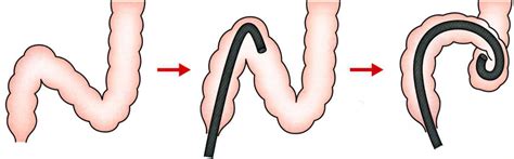 Image result for Colono Looping Colonoscopy