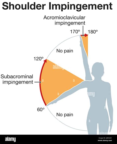 Shoulder Impingement Diagnosis
